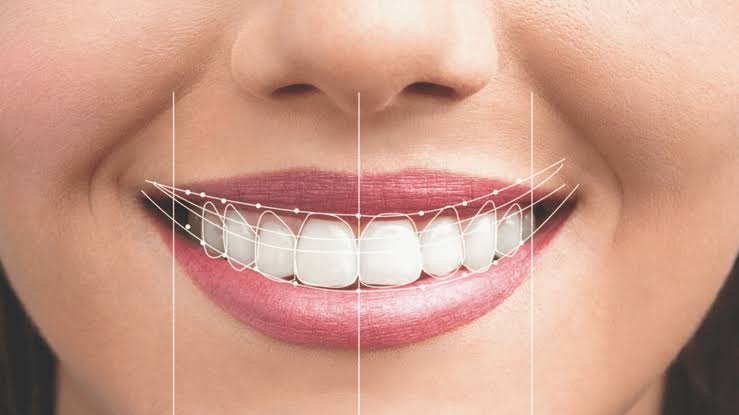 Diseño de sonrisa