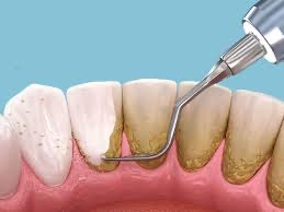 Limpieza y profilaxis dental