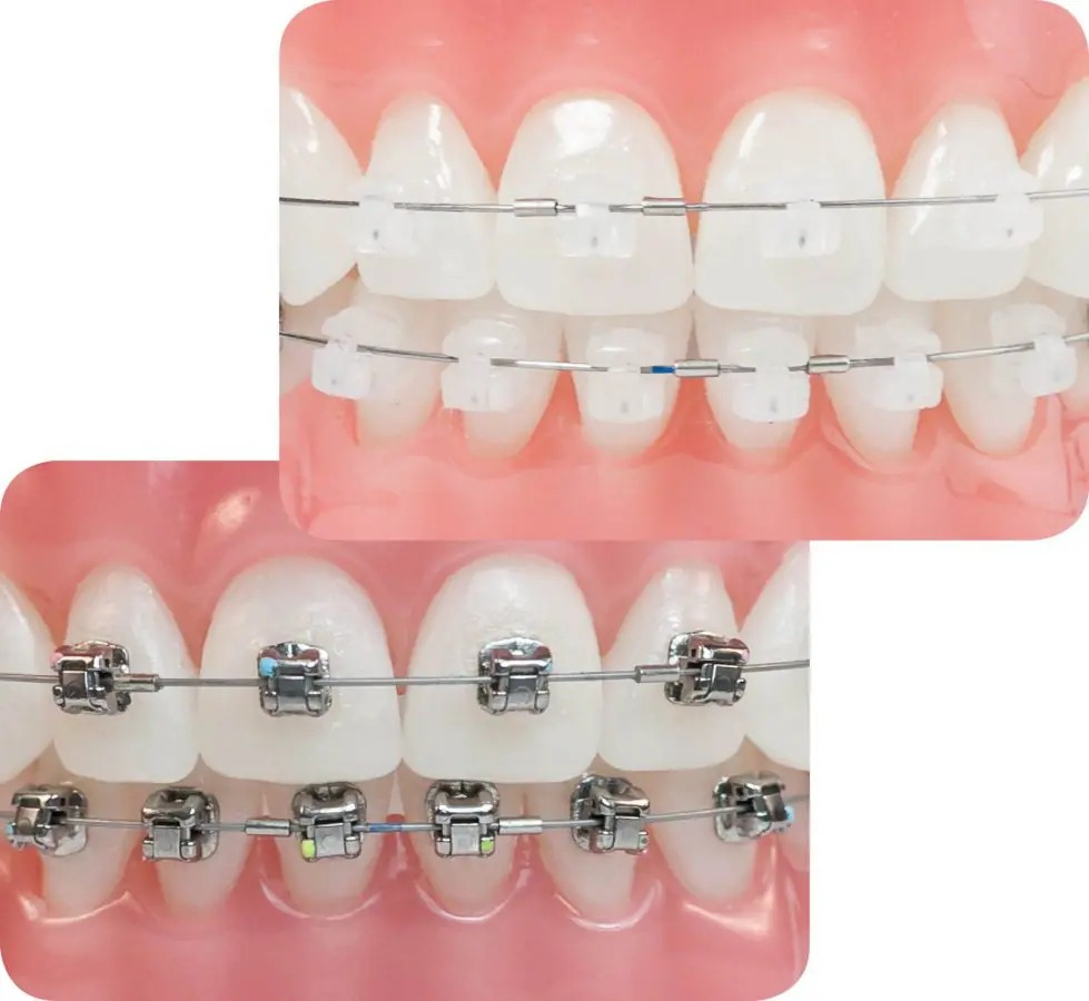 Ortodoncia de brackets estéticos