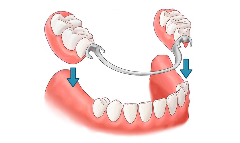 Puentes dentales