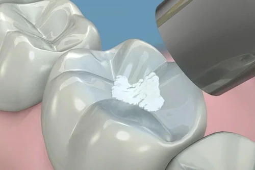 Resina dental