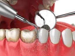 Tratamientos periodontales